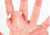 What to do if your child has peeling skin on his fingers